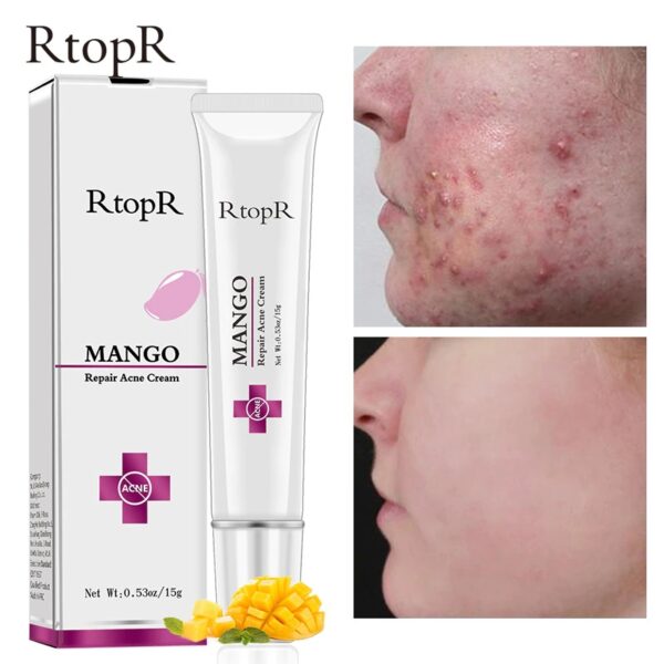 RTOPR Mango Repair Acne Cream 15g 01