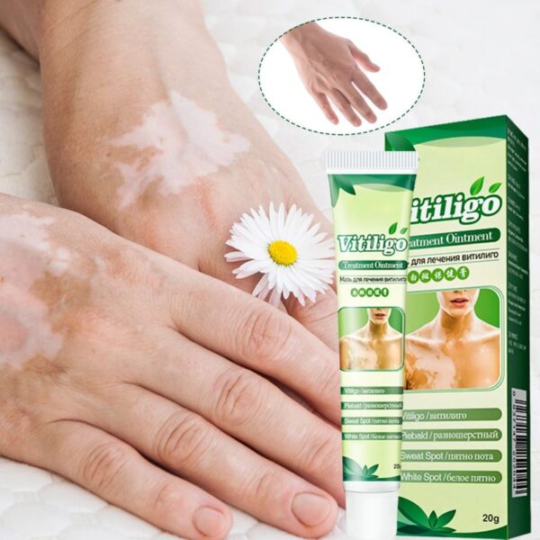 Vitiligo Treatment Cream Skin Pigmentation Treatment Vitiligo Care Cream Or Skin Vitiligo Leukoplakia Improve Skin Pigmentation.jpg Q90.jpg 800x800 1